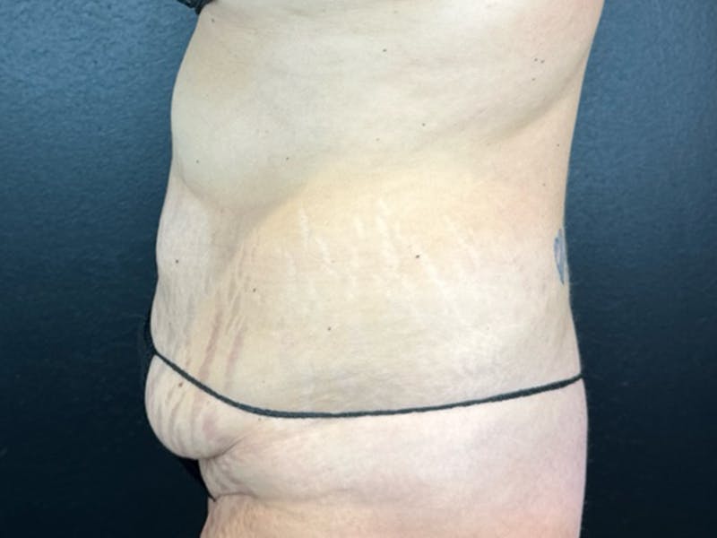 Tummy Tuck Before & After Gallery - Patient 123893 - Image 1