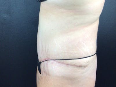 Tummy Tuck Before & After Gallery - Patient 123893 - Image 2