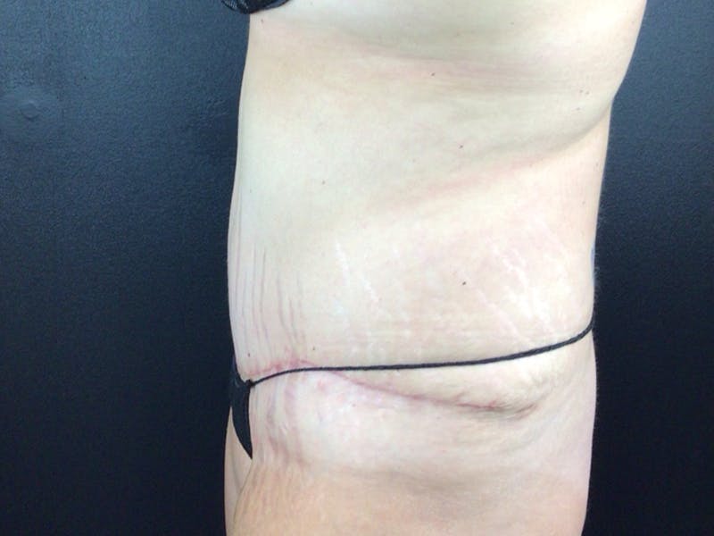 Tummy Tuck Before & After Gallery - Patient 123893 - Image 2