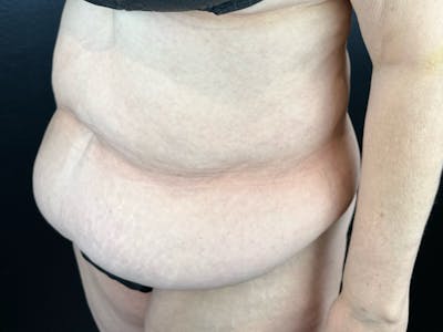 Tummy Tuck Before & After Gallery - Patient 407317 - Image 1