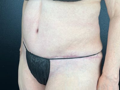 Tummy Tuck Before & After Gallery - Patient 407317 - Image 2