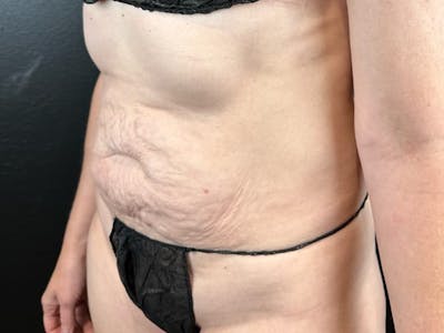 Tummy Tuck Before & After Gallery - Patient 794493 - Image 1