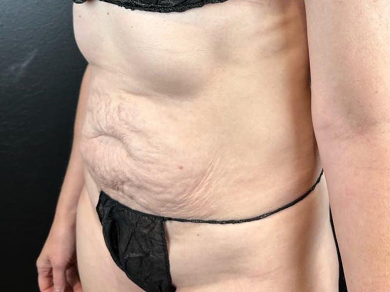 Tummy Tuck Before & After Gallery - Patient 794493 - Image 1