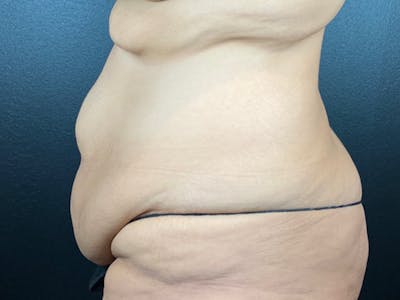 Tummy Tuck Before & After Gallery - Patient 136920 - Image 1
