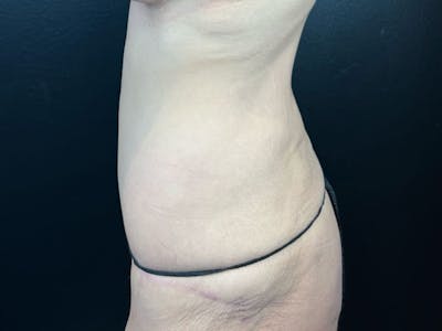 Tummy Tuck Before & After Gallery - Patient 136920 - Image 2