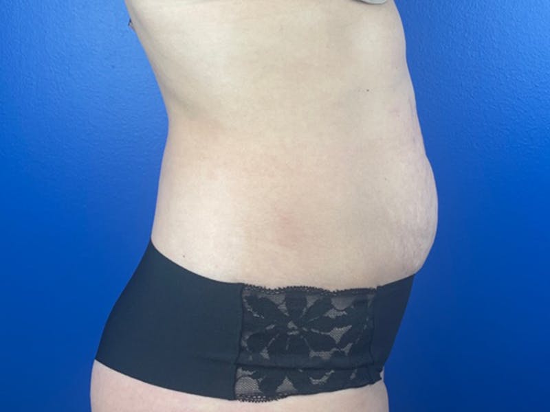 Tummy Tuck Before & After Gallery - Patient 125135 - Image 1