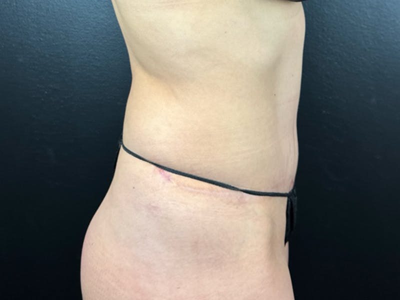 Tummy Tuck Before & After Gallery - Patient 125135 - Image 2