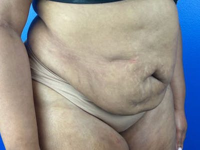 Tummy Tuck Before & After Gallery - Patient 385631 - Image 1
