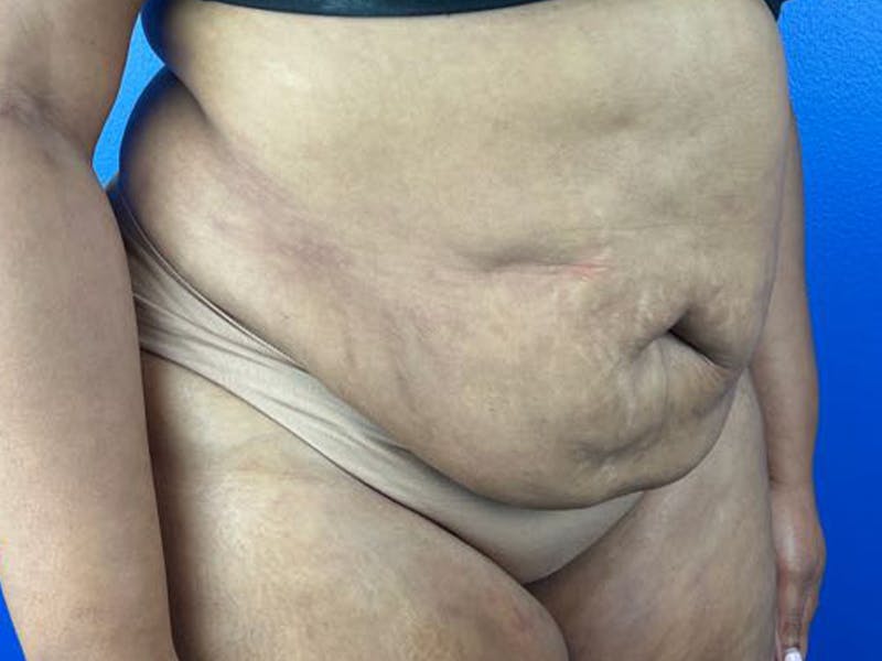 Tummy Tuck Before & After Gallery - Patient 385631 - Image 1