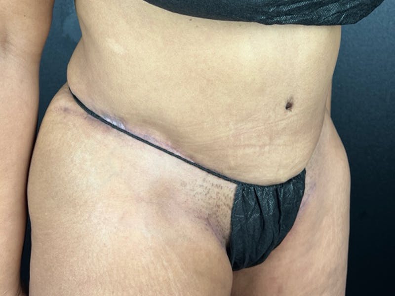 Tummy Tuck Before & After Gallery - Patient 385631 - Image 2