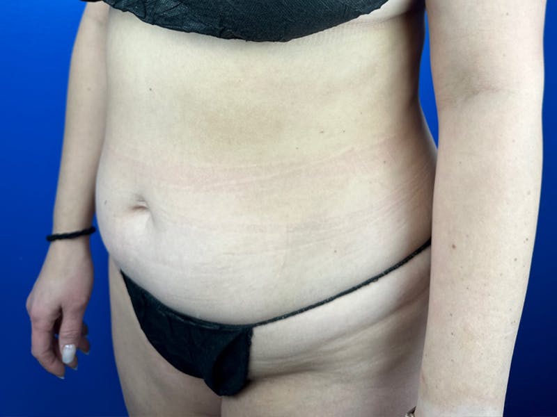 Tummy Tuck Before & After Gallery - Patient 364767 - Image 3