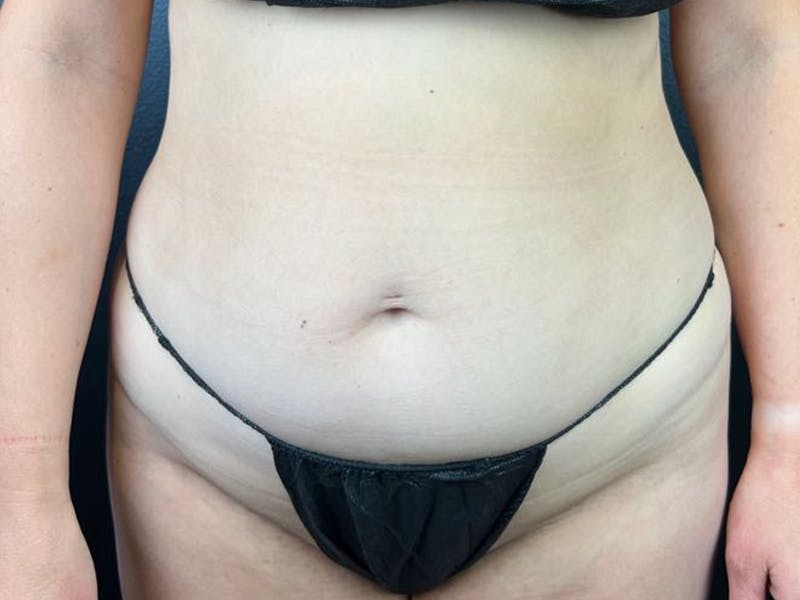 Tummy Tuck Before & After Gallery - Patient 364767 - Image 1