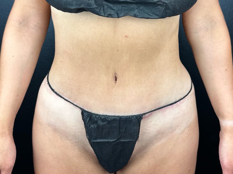 Tummy Tuck Before & After Gallery - Patient 364767 - Image 2