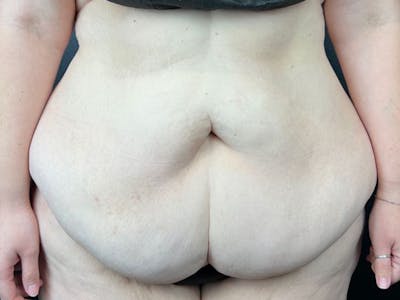 Tummy Tuck Before & After Gallery - Patient 355370 - Image 1
