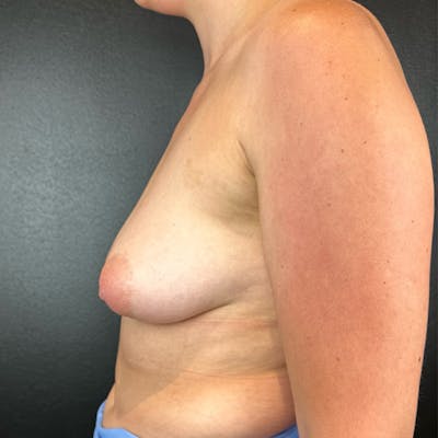 Breast Augmentation Before & After Gallery - Patient 397250 - Image 1