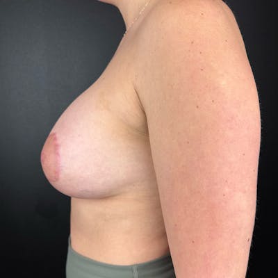 Breast Augmentation Before & After Gallery - Patient 397250 - Image 2