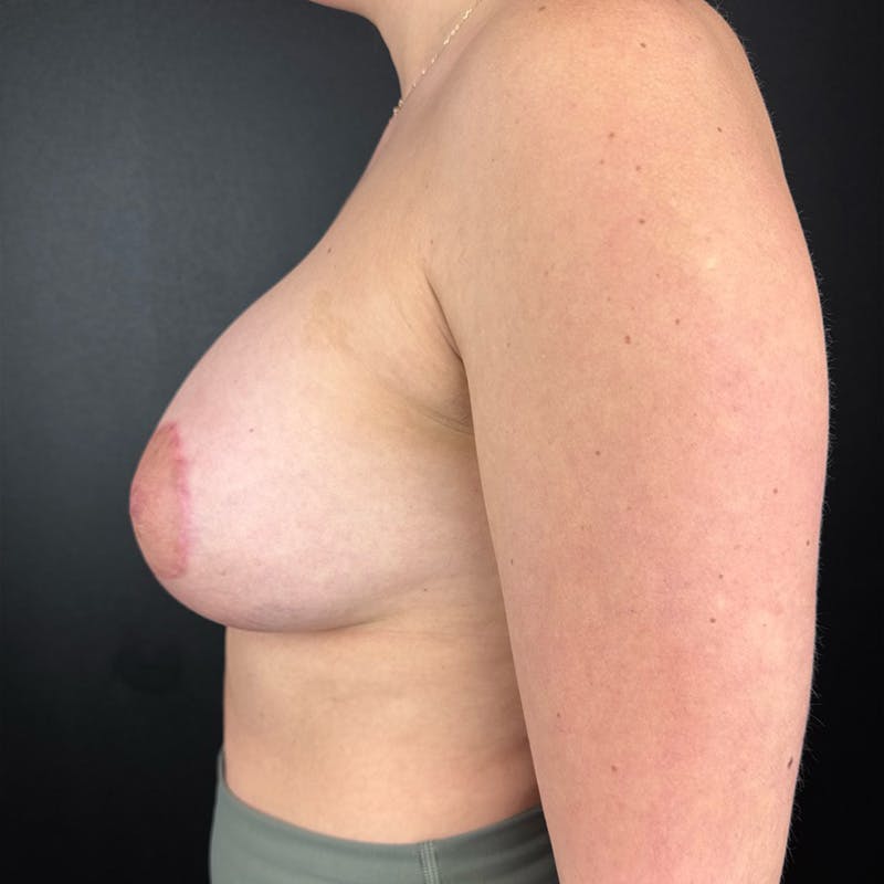 Breast Augmentation Before & After Gallery - Patient 397250 - Image 2