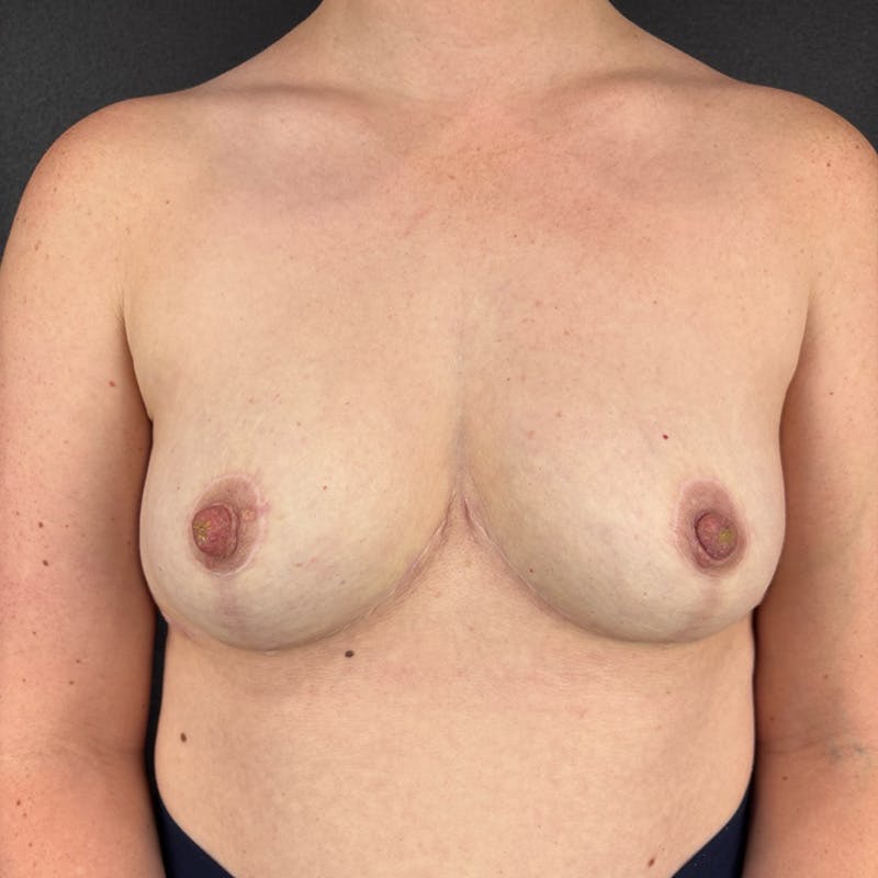 Breast Lift Before & After Gallery - Patient 128372 - Image 2