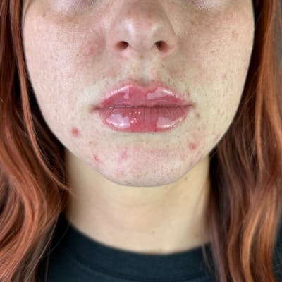 Lip Filler Before & After Gallery - Patient 903470 - Image 2