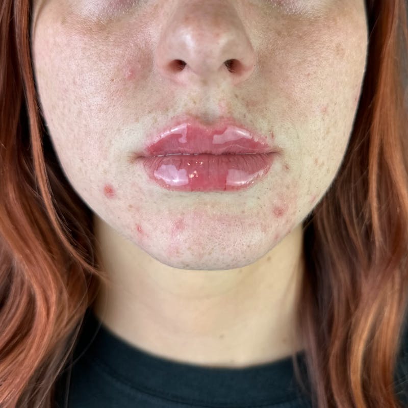 Lip Filler Before & After Gallery - Patient 903470 - Image 2