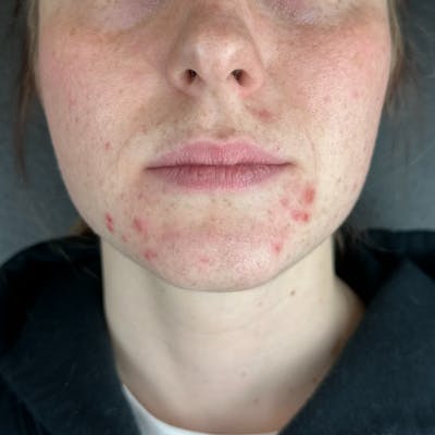Lip Filler Before & After Gallery - Patient 903470 - Image 1