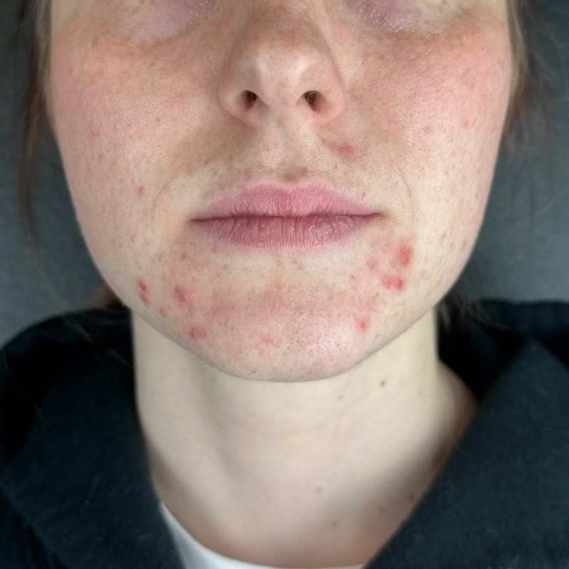 Lip Filler Before & After Gallery - Patient 903470 - Image 1