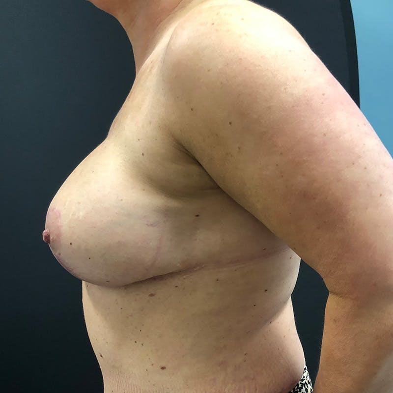 Autologous Tissue Reconstruction Before & After Gallery - Patient 432752 - Image 4