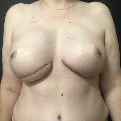 Autologous Tissue Reconstruction Before & After Gallery - Patient 414205 - Image 1