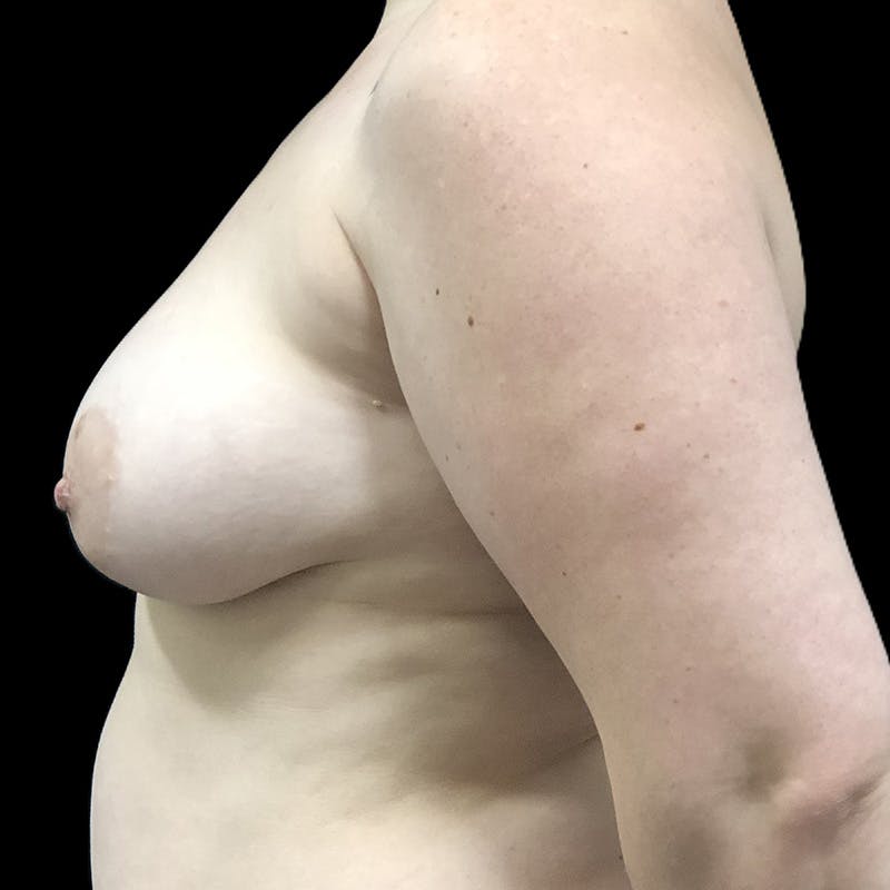 Autologous Tissue Reconstruction Before & After Gallery - Patient 347166 - Image 3