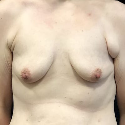 DIEP Flap Before & After Gallery - Patient 174527 - Image 1