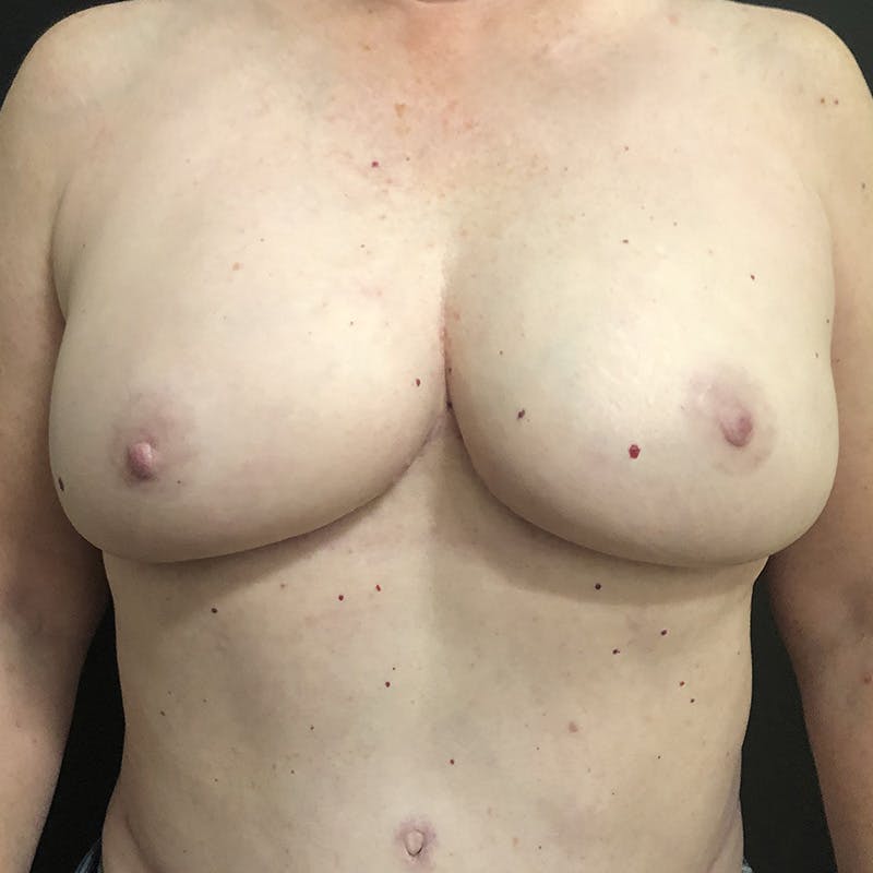 DIEP Flap Before & After Gallery - Patient 275136 - Image 2