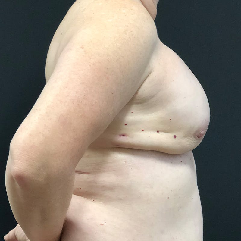 DIEP Flap Before & After Gallery - Patient 275136 - Image 3