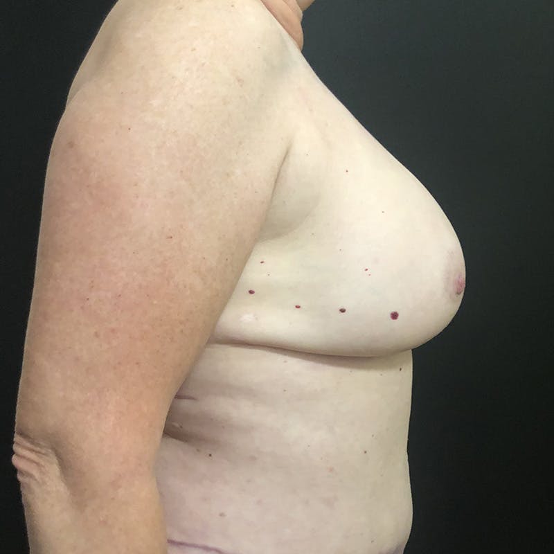 DIEP Flap Before & After Gallery - Patient 275136 - Image 4