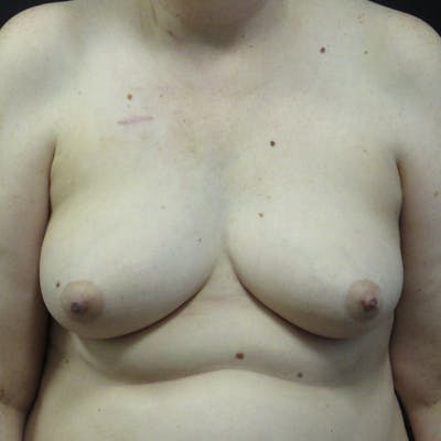 DIEP Flap Before & After Gallery - Patient 315410 - Image 1