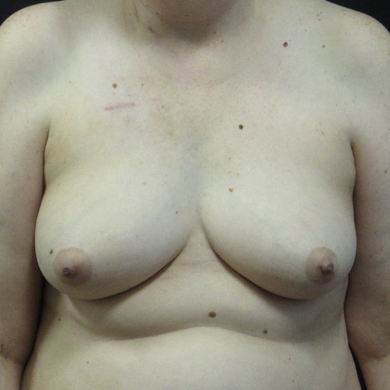 DIEP Flap Before & After Gallery - Patient 315410 - Image 1
