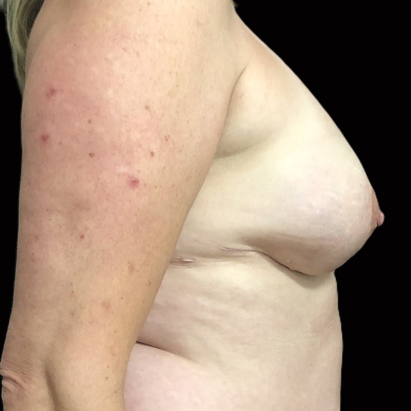 DIEP Flap Before & After Gallery - Patient 118015 - Image 3