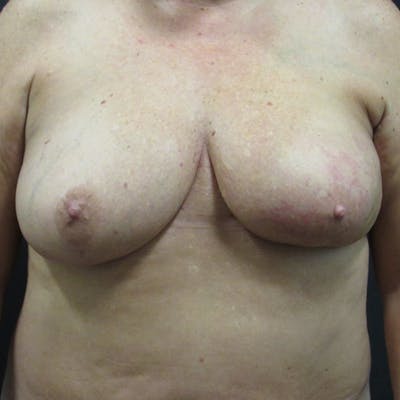 DIEP Flap Before & After Gallery - Patient 180586 - Image 1