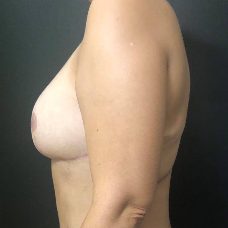 DIEP Flap Before & After Gallery - Patient 318545 - Image 6