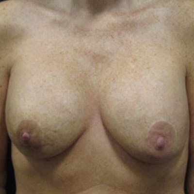 Implant Reconstruction Before & After Gallery - Patient 367171 - Image 1