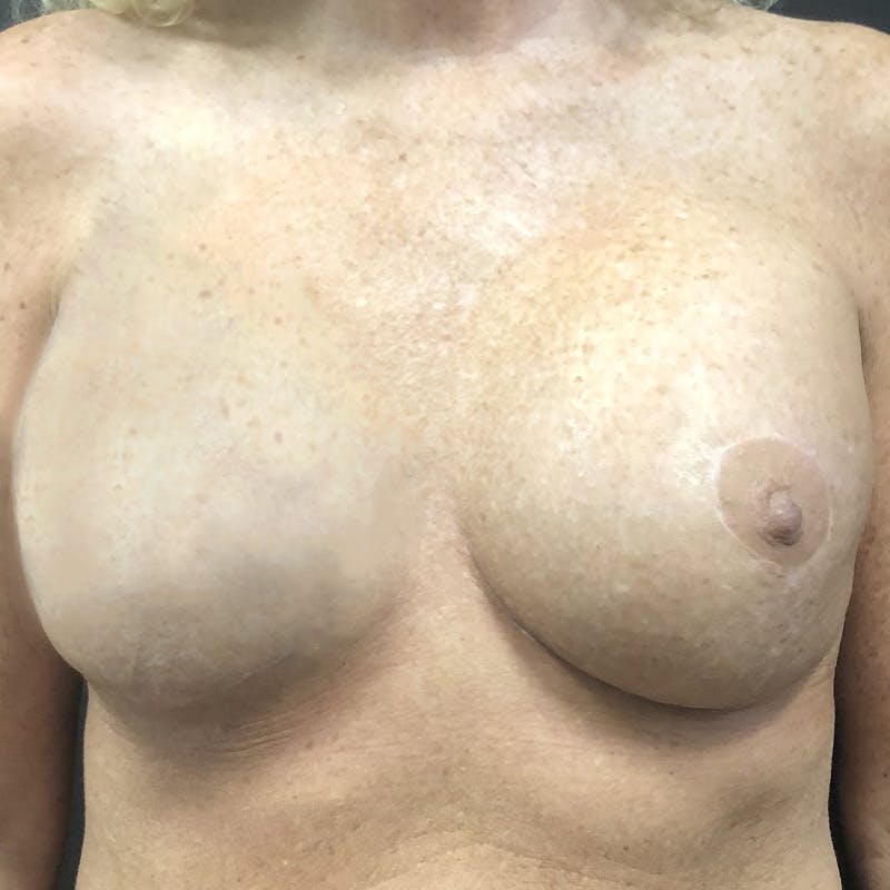 Implant Reconstruction Before & After Gallery - Patient 367171 - Image 2