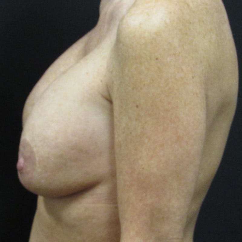 Implant Reconstruction Before & After Gallery - Patient 367171 - Image 3