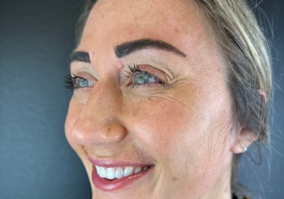 Wrinkle Relaxer Before & After Gallery - Patient 110000 - Image 1