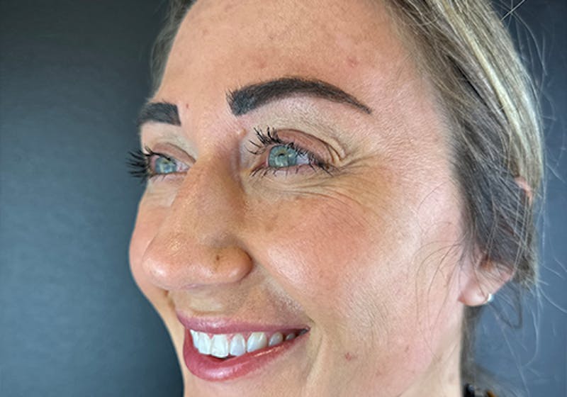 Wrinkle Relaxer Before & After Gallery - Patient 110000 - Image 1
