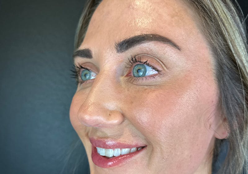 Wrinkle Relaxer Before & After Gallery - Patient 110000 - Image 2