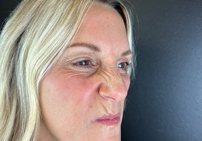 Wrinkle Relaxer Before & After Gallery - Patient 372388 - Image 1
