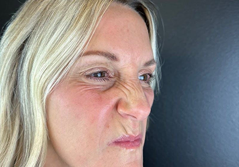 Wrinkle Relaxer Before & After Gallery - Patient 372388 - Image 1