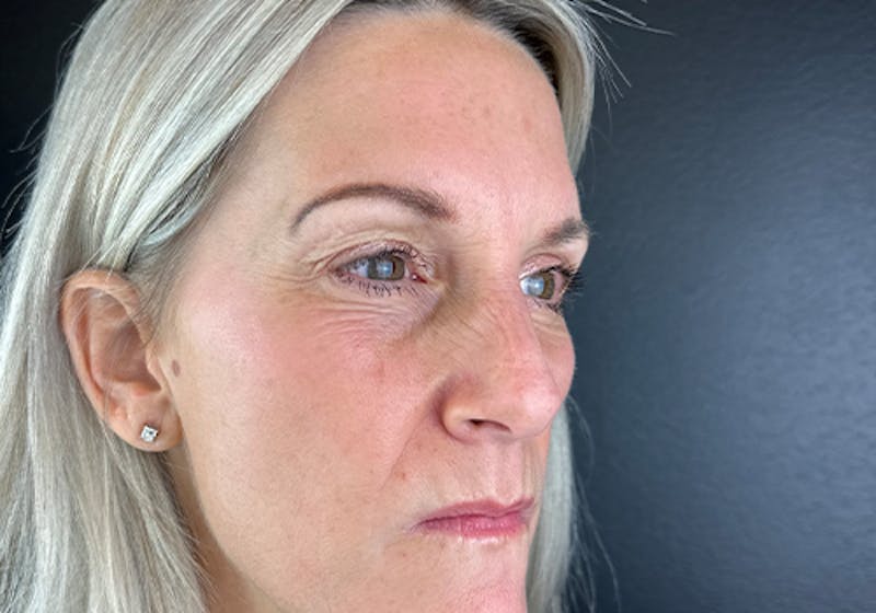 Wrinkle Relaxer Before & After Gallery - Patient 372388 - Image 2