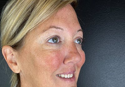 Wrinkle Relaxer Before & After Gallery - Patient 616164 - Image 2