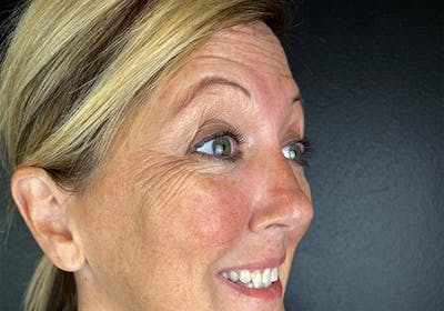 Wrinkle Relaxer Before & After Gallery - Patient 616164 - Image 1