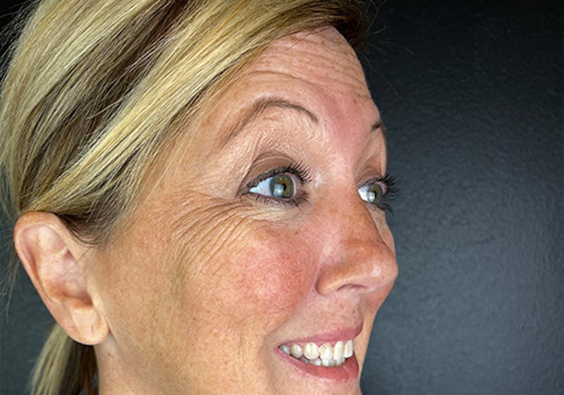 Wrinkle Relaxer Before & After Gallery - Patient 616164 - Image 1